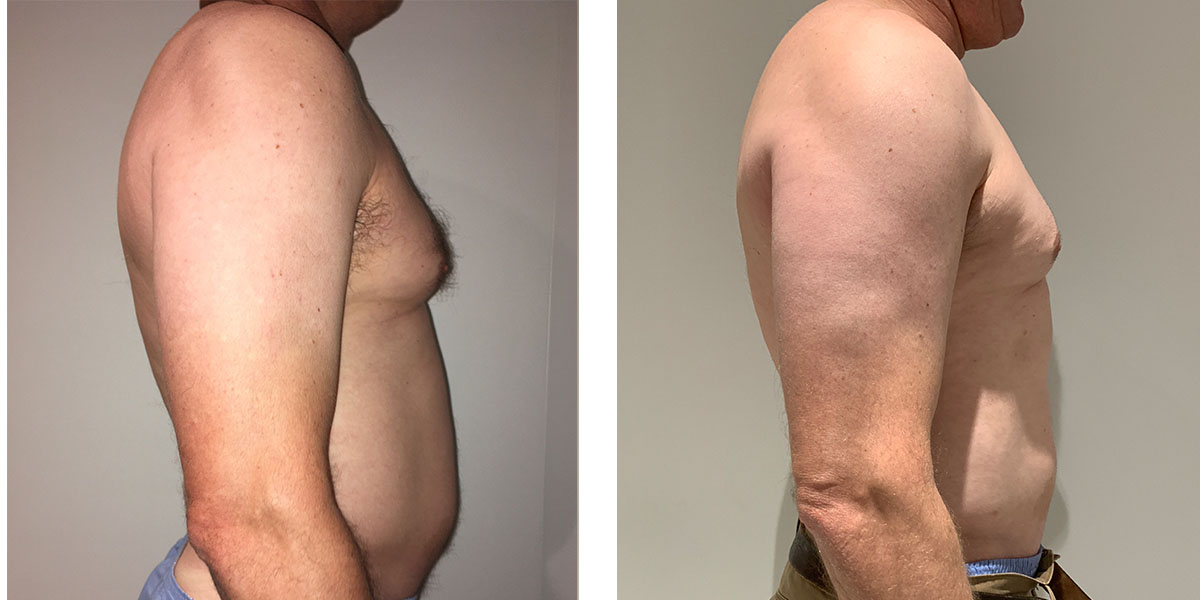 46 Year Old Male - Liposuction - bodybyZ