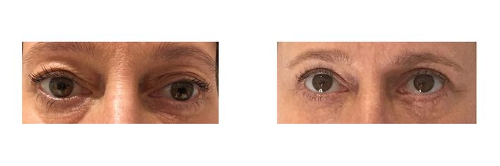 Eyelid Surgery - bodybyZ