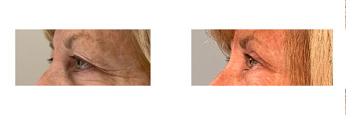 57 Year Old Female - Eyelid Surgery - bodybyZ