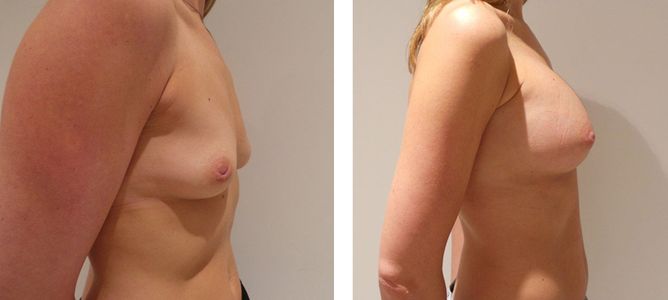35 Year Old Female - Breast Augmentation