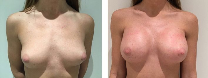 26 Year Old Female - Breast Augmentation