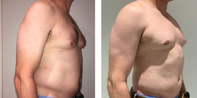 46 Year Old Male - Liposuction - bodybyZ