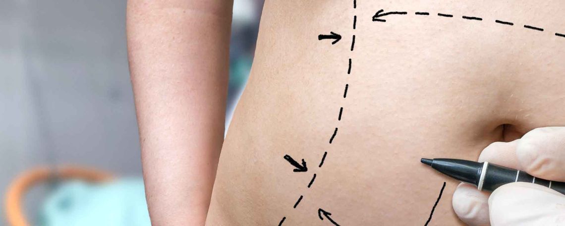 Tummy Tuck Blog Post