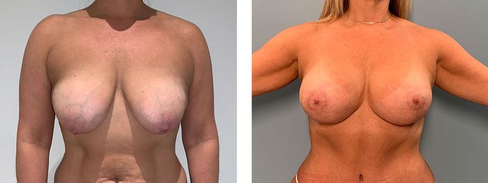 45 Year Old Female - Breast Revision - bodybyZ