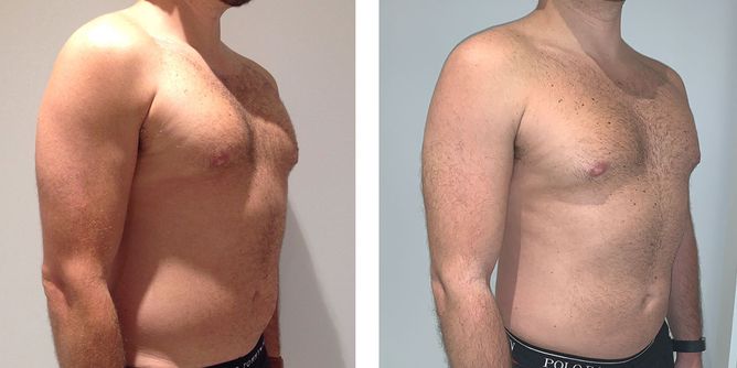 29 Year Old Male - Liposuction - bodybyZ