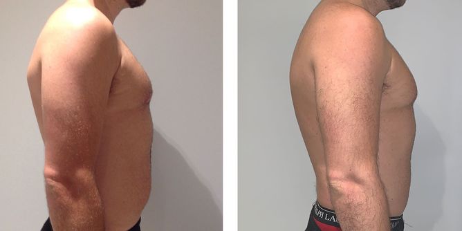 29 Year Old Male - Liposuction - bodybyZ