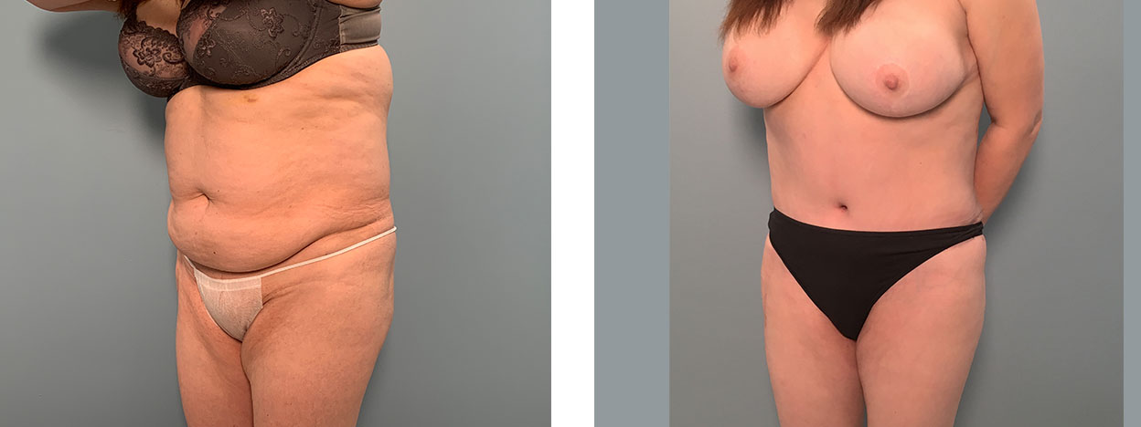 56 Year Old Female - Tummy Tuck Surgery - bodybyZ