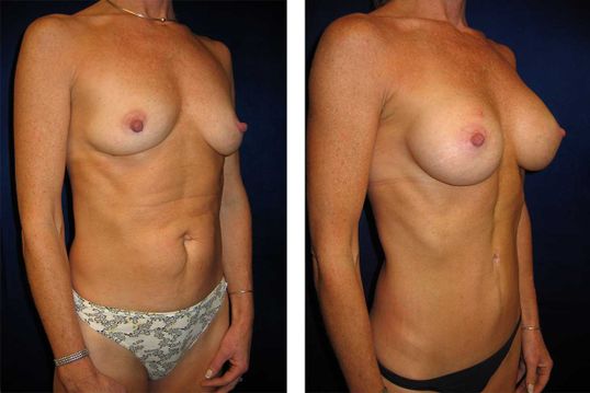 45 Year Old Mother - TABA - bodybyZ