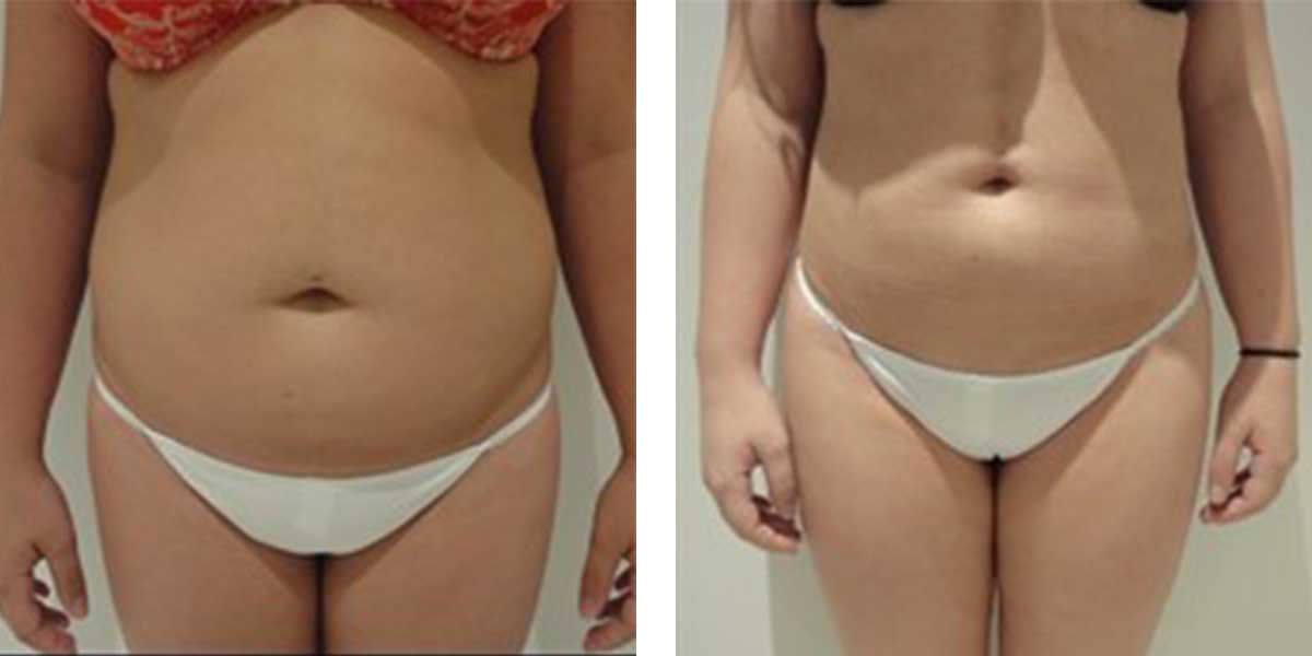 26 Year Old Female - Liposuction - bodybyZ