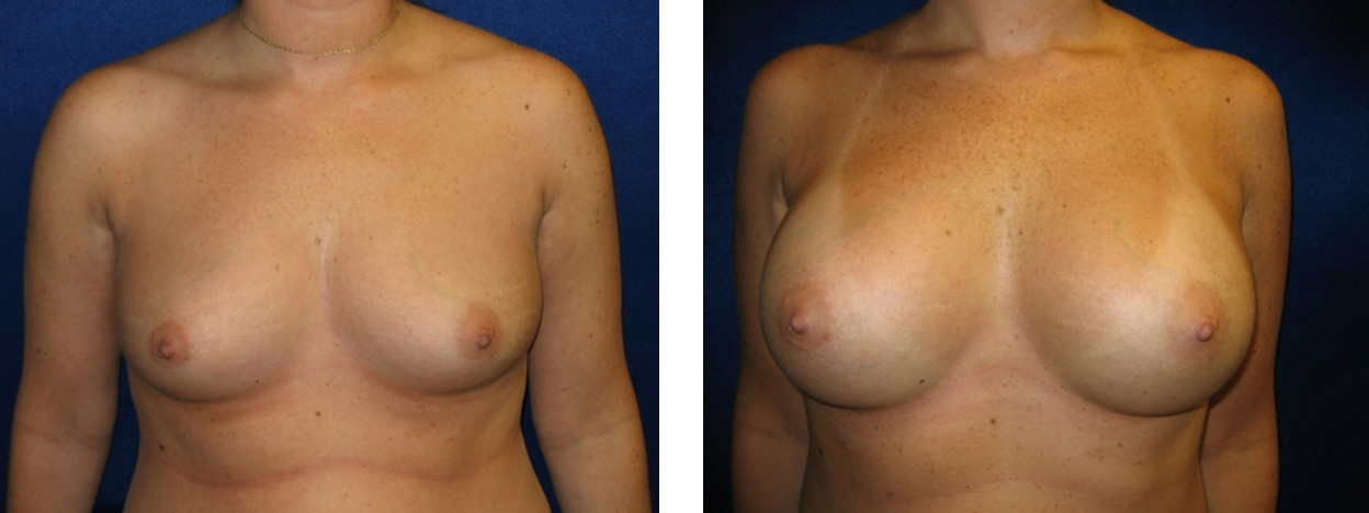 Breast Augmentation - bodybyZ