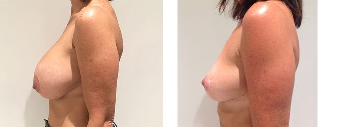 43 Year Old Female - Breast Revision - bodybyZ