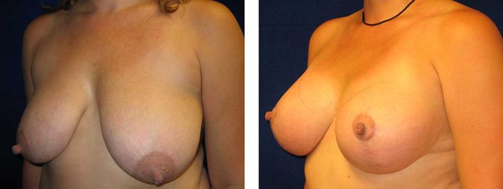 32 Year Old Female - Breast Revision - bodybyZ