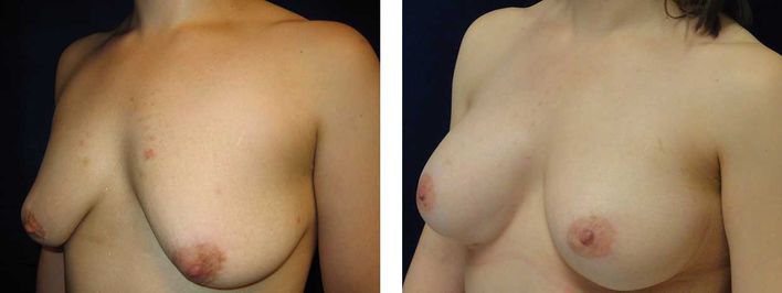 28 Year Old Female - Breast Revision - bodybyZ