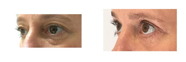 Eyelid Surgery - bodybyZ