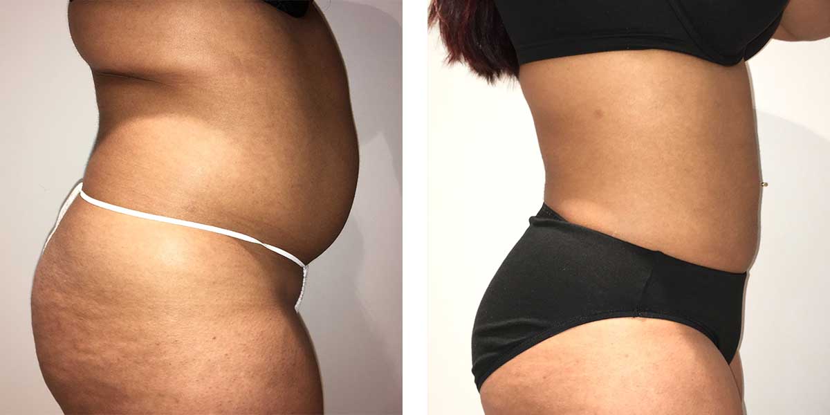 30 Year Old Female - Liposuction - bodybyZ