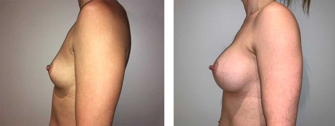 30 Year Old Female - Breast Augmentation