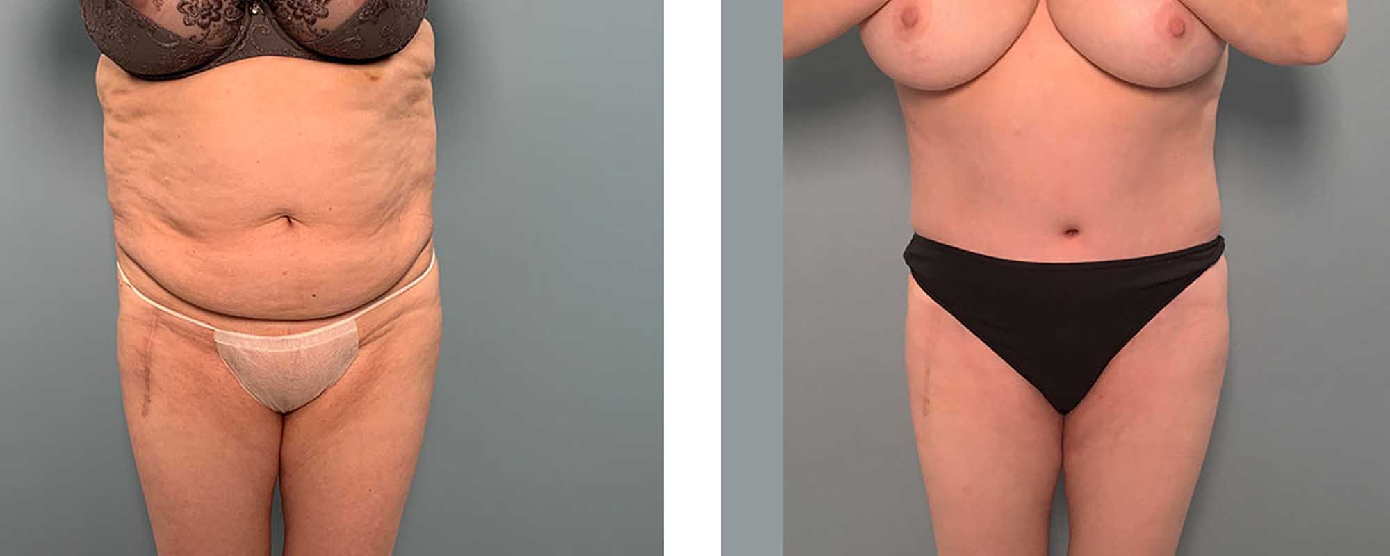 Tummy Tuck Austin Tx