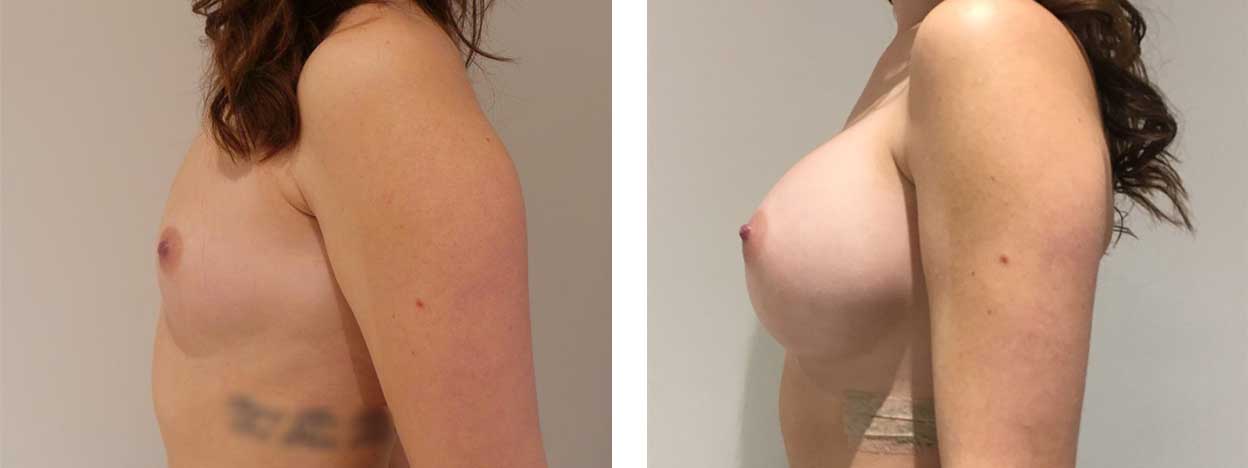 28 Year Old Female - Breast Augmentation