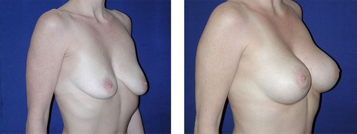 49 Year Old Female - Breast Lift - bodybyZ
