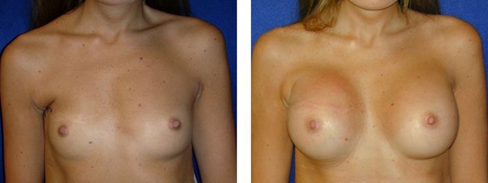 23 Year Old Female - Breast Revision - bodybyZ
