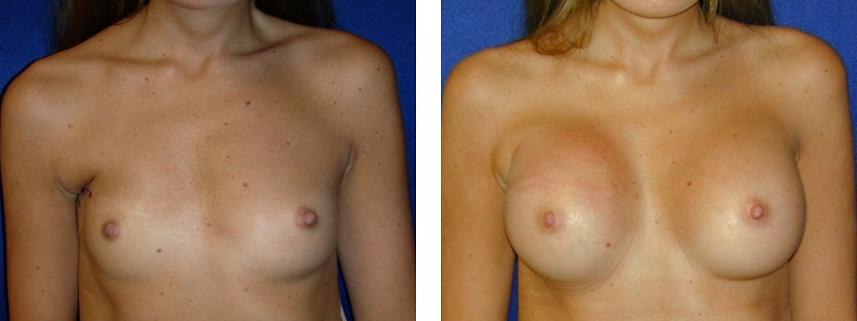 23 Year Old Female - Breast Revision - bodybyZ
