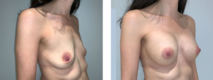43 year old female - Breast Augmentation