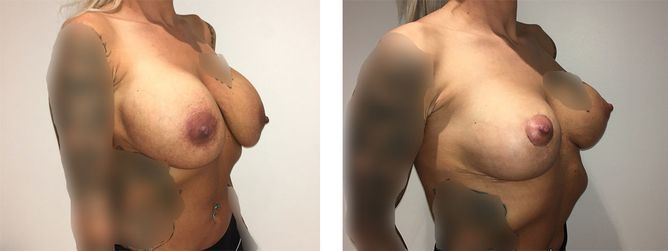 36 Year Old Female - Breast Revision - bodybyZ