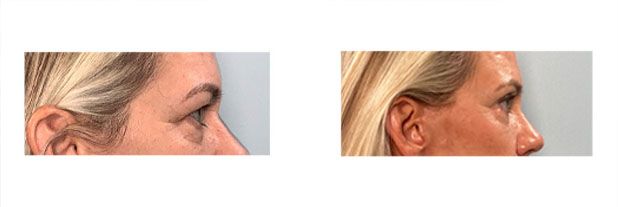 Eyelid and Face lift