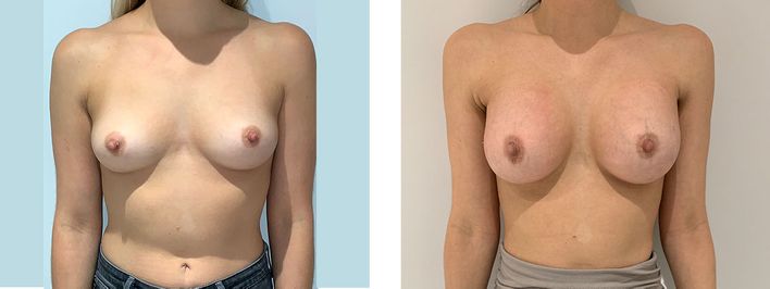 34 Year Old Female - Transaxilary Breast Augmentation