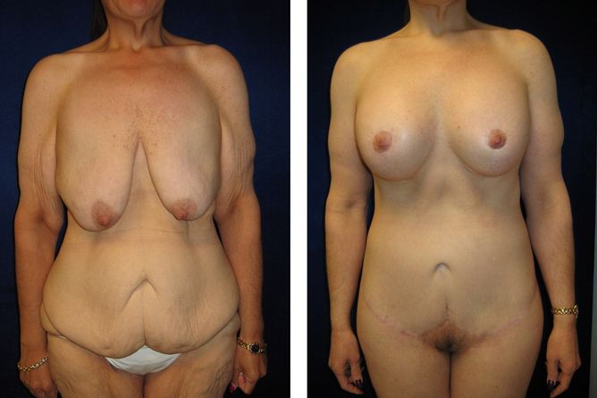 50 Year Old Female - Major Weight Loss Surgery - bodybyZ