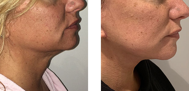 47 Year Old Female - Face Lift 