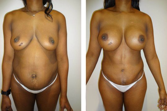 44 Year Old Female - TABA - bodybyZ