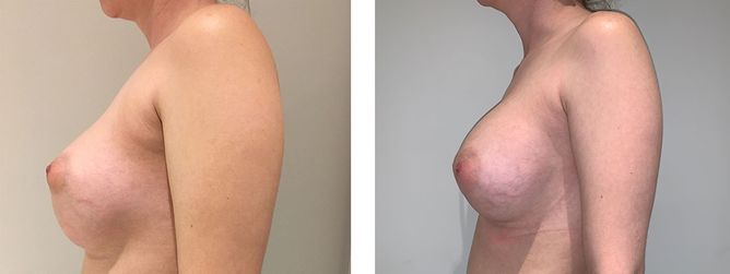 28 Year Old Female - Breast Revision - bodybyZ