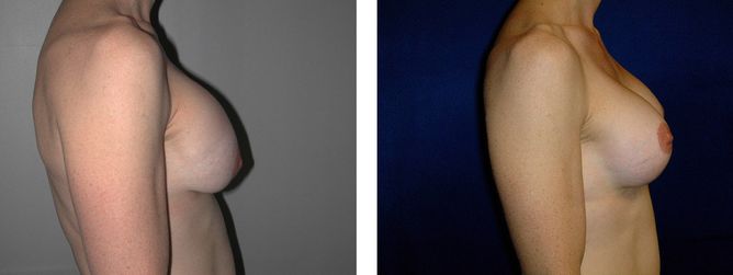 42 Year Old Female - Breast Revision - bodybyZ