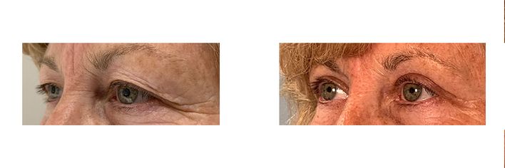 57 Year Old Female - Eyelid Surgery - bodybyZ