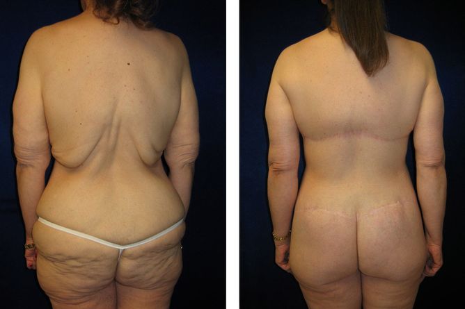 50 Year Old Female - Major Weight Loss Surgery - bodybyZ