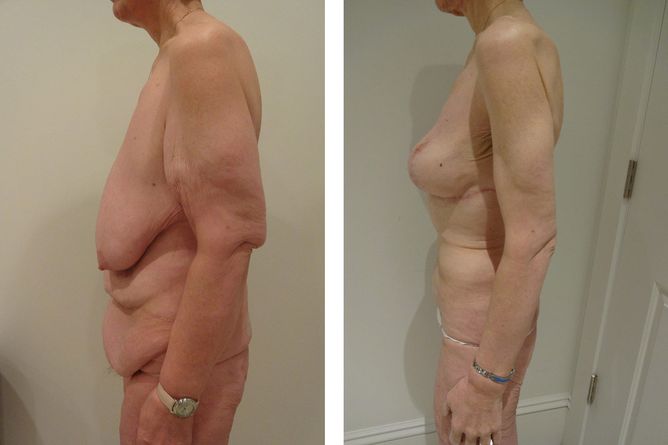 50 Year Old Female - Major Weight Loss Surgery - bodybyZ