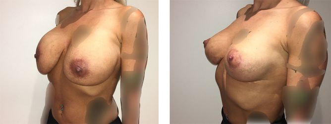 36 Year Old Female - Breast Revision - bodybyZ
