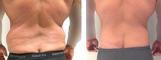 40 Year Old Male - Tummy Tuck Surgery