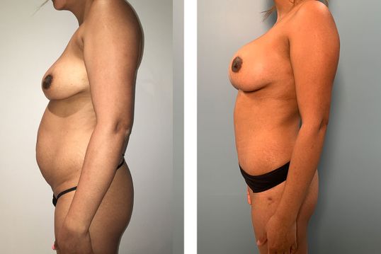 29 Year Old Female - TABA - bodybyZ
