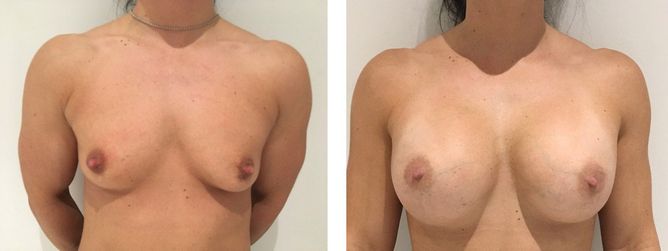 30 Year Old Female - Breast Augmentation