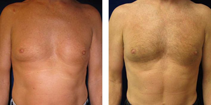45 Year Old Male - Liposuction - bodybyZ