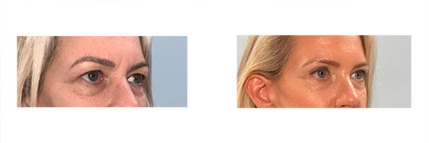 Eyelid and Face lift