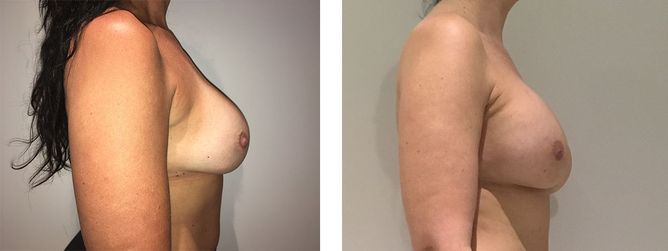40 Year Old Female - Breast Revision - bodybyZ