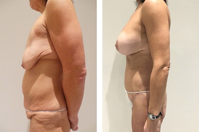 45 Year Old Female - Major Weight Loss Surgery - bodybyZ