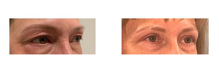 55 Year Old Female - Eyelid Surgery - bodybyZ
