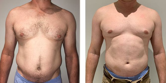 46 Year Old Male - Liposuction - bodybyZ