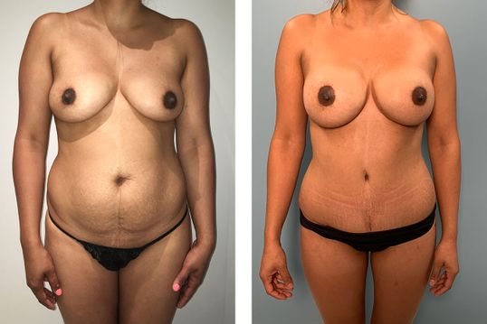 29 Year Old Female - TABA - bodybyZ