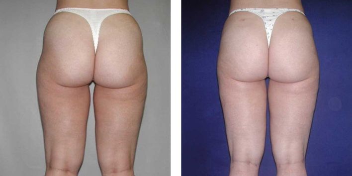 29 Year Old Female - Liposuction - bodybyZ