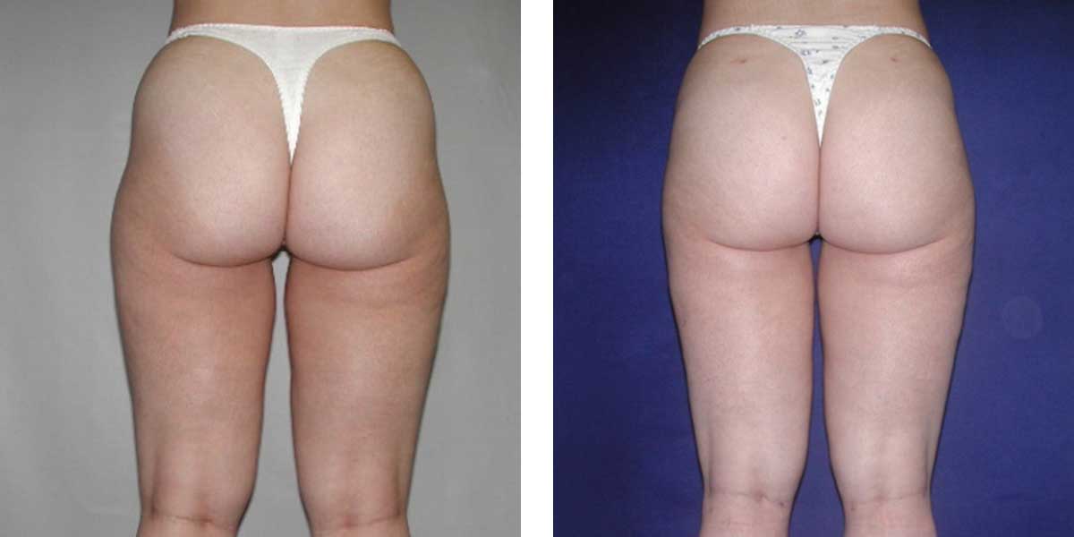 29 Year Old Female - Liposuction - bodybyZ